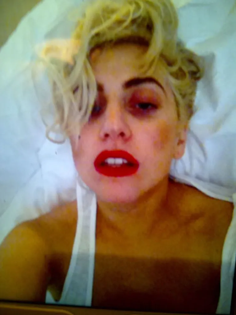 Dziedātāja Lady Gaga savā Twitter kontā publicējusi fotogrāfiju, kurā zem viņas acīm redzami lieli zilumi 