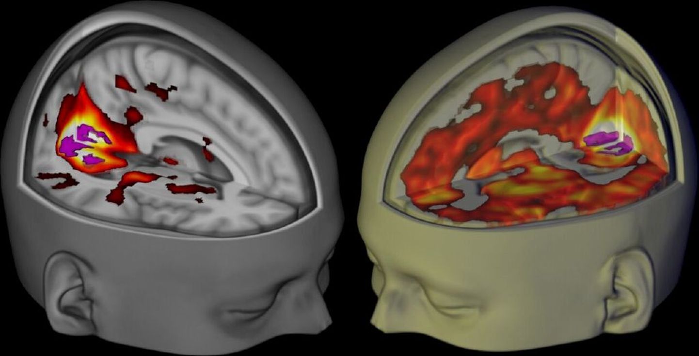 Активность мозга под действием ЛСД (справа).