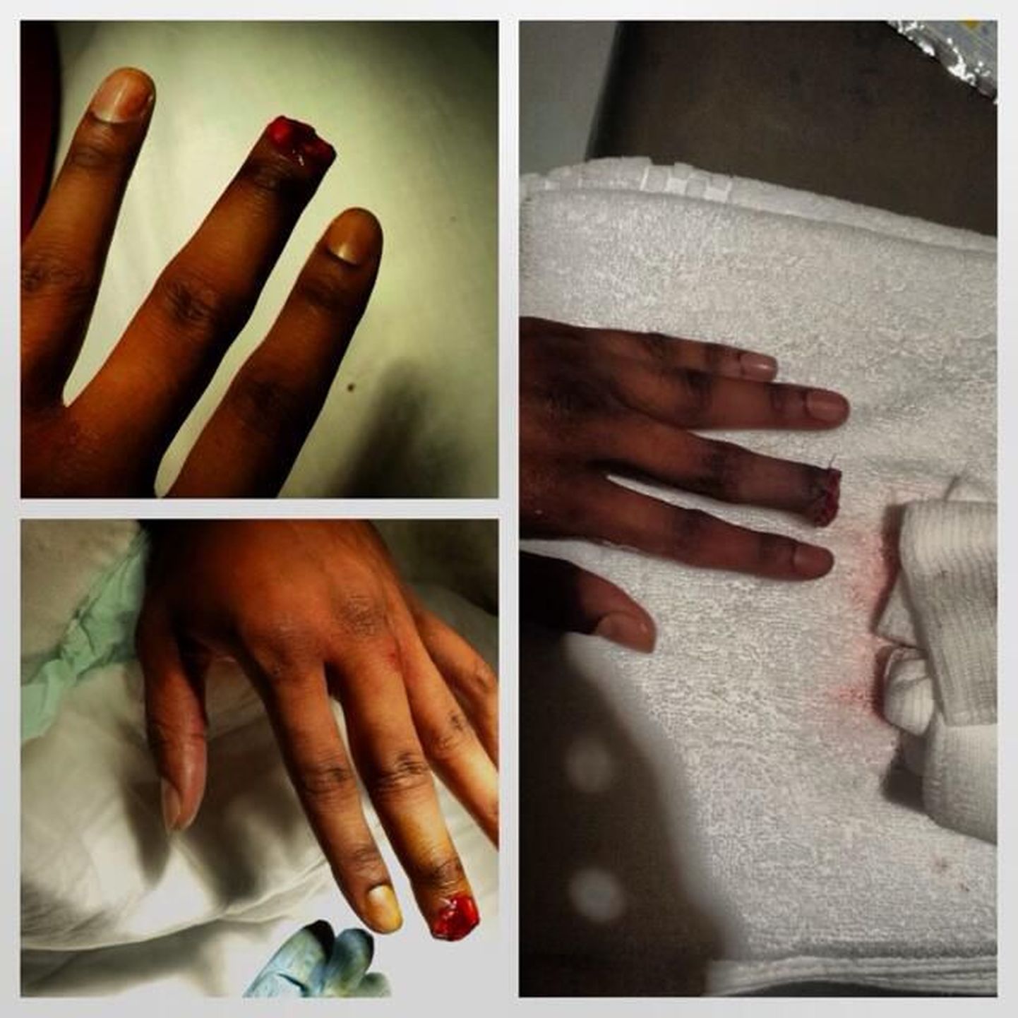 Rashaad Johnson postitas Twitterisse fotod oma katkisest sõrmest.