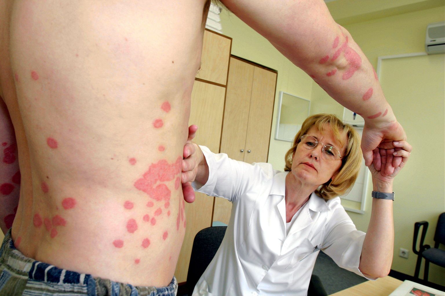 Psoriaasiga patsient.