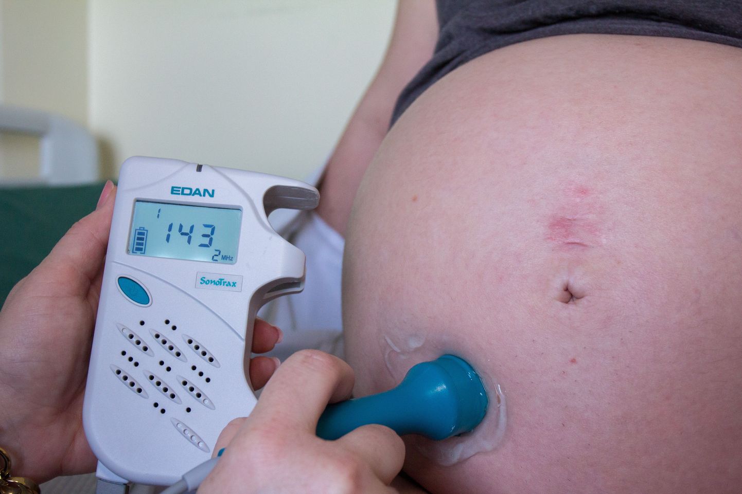 Kõhusoleva beebi südametegevuse vaatlemine Viljandi haigla sünnitusosakonnas.