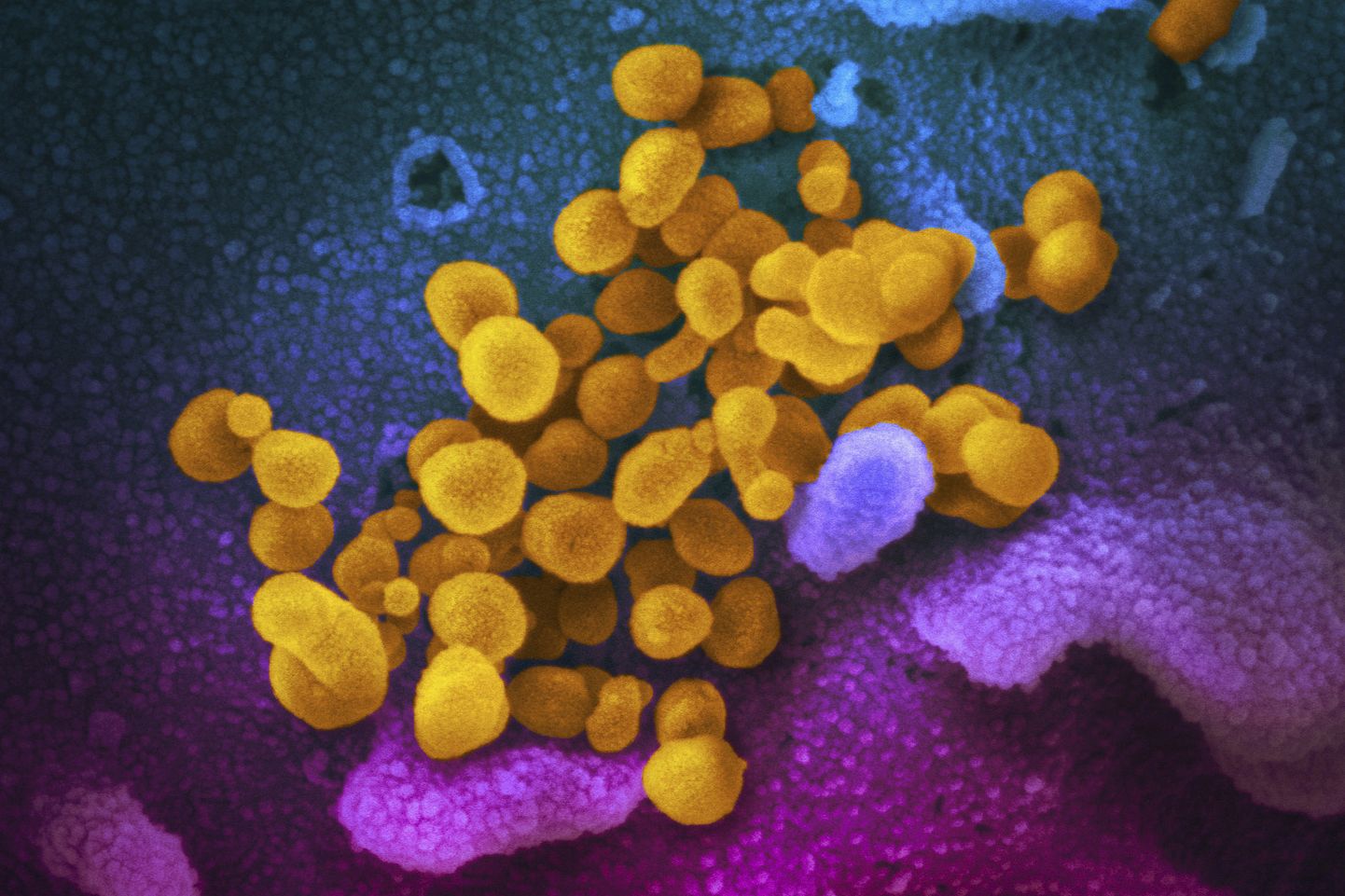 Uus koroonaviirus SARS-CoV-2, mis on elektronmikroskoobifotol näha kollasena