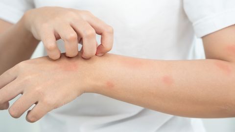 PANE TÄHELE! ⟩ Reisilt saadud lööve ei ole alati süütu: arstid hoiatavad ohtlike sümptomite eest