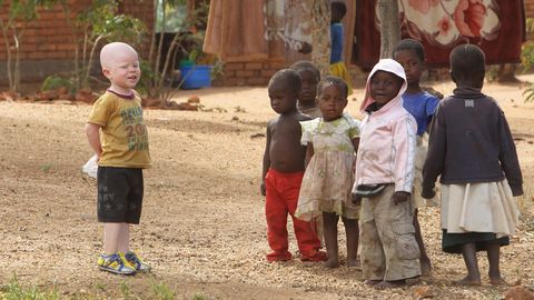 Malawi kohus mõistis surma albiinonooruki tapnud mehe