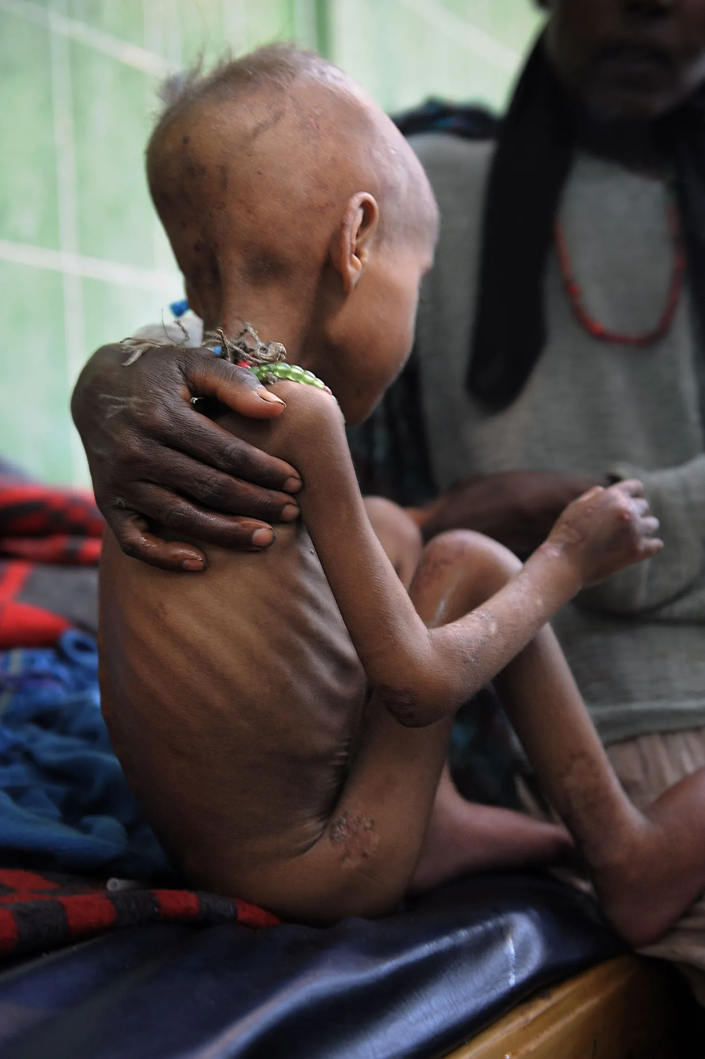 Alatoidetud laps Etioopias