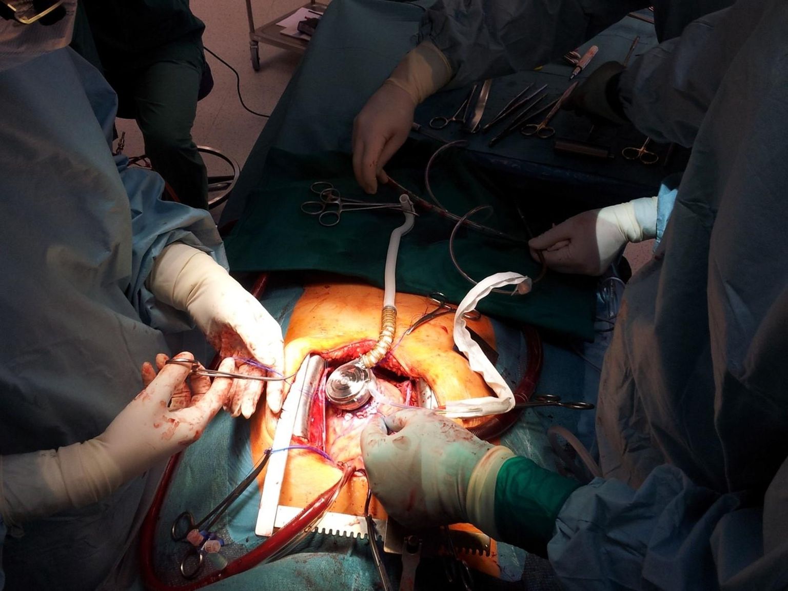 Vaade lõikusele, kus kirurg Arno Ruusalepp paigaldab patsiendi südame külge pumba, mis aitab südamelihasel tööd teha. Ilma selleta ei õnnestuks paljudel patsientidel siirdamiseni vastu pidada.