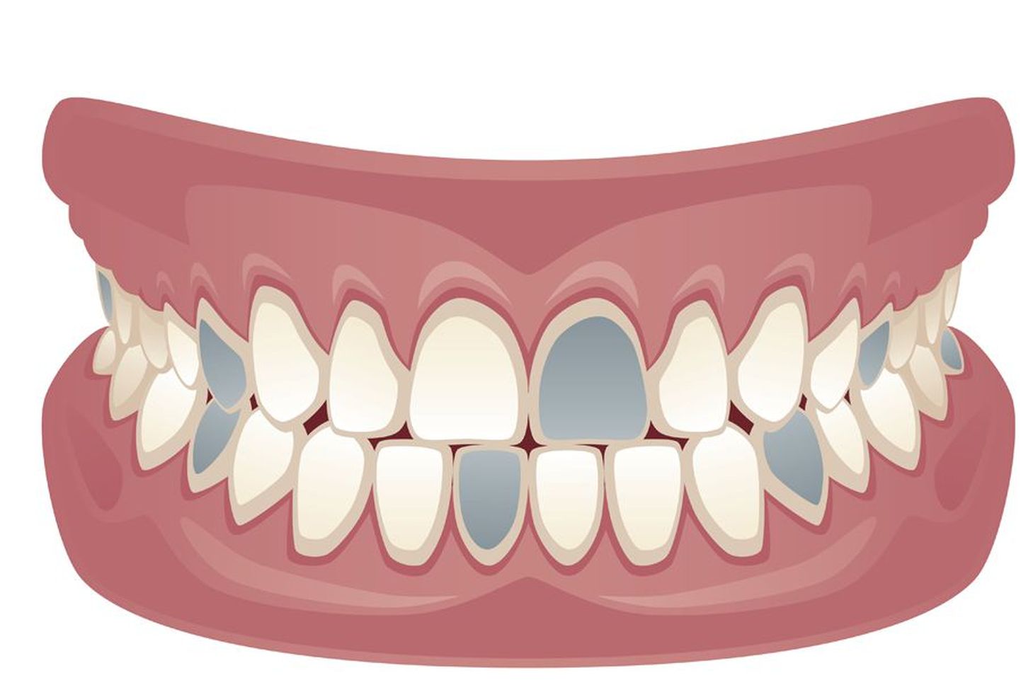 Halliks värvitud hambad illustreerivad neljandikku hambaraviteenuse pakkujatest, kes on täiskasvanute hambaravihüvitise süsteemiga liitunud.