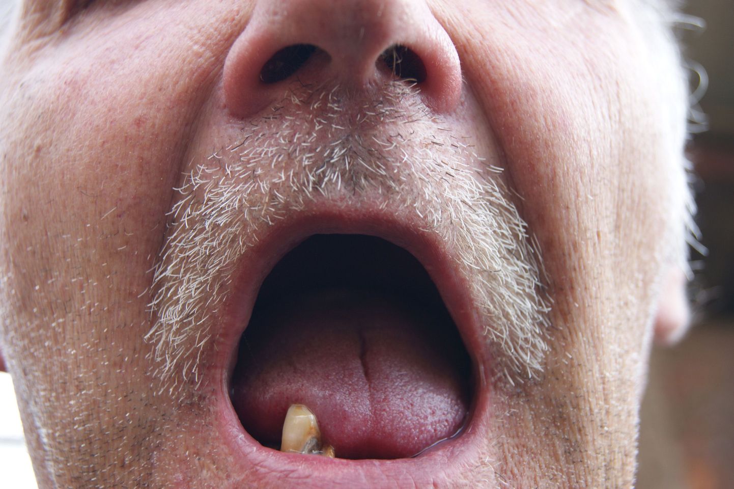 Редкая чистка зубов приводит в плачевным последствиям.