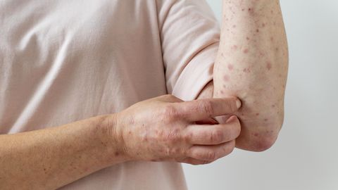 Measles Spreads Again in US, Cases Hit 35-Year High