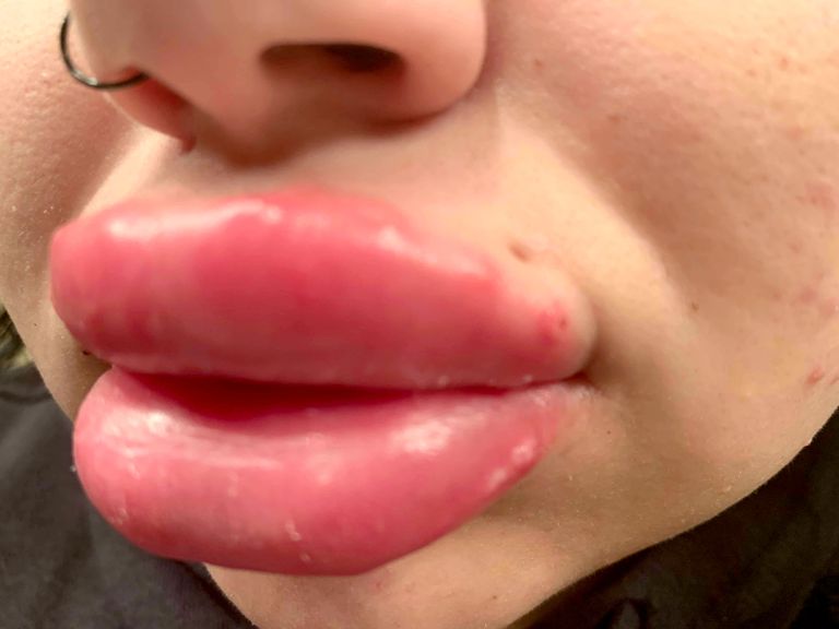 Tal diagnoositi huultes infektsioon ning nüüd kardab ta, et tema huuled mädanevad otsast ära.