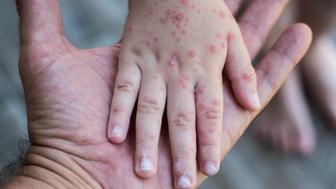 Latvijā turpinās masalu uzliesmojums — jau 31 saslimušais