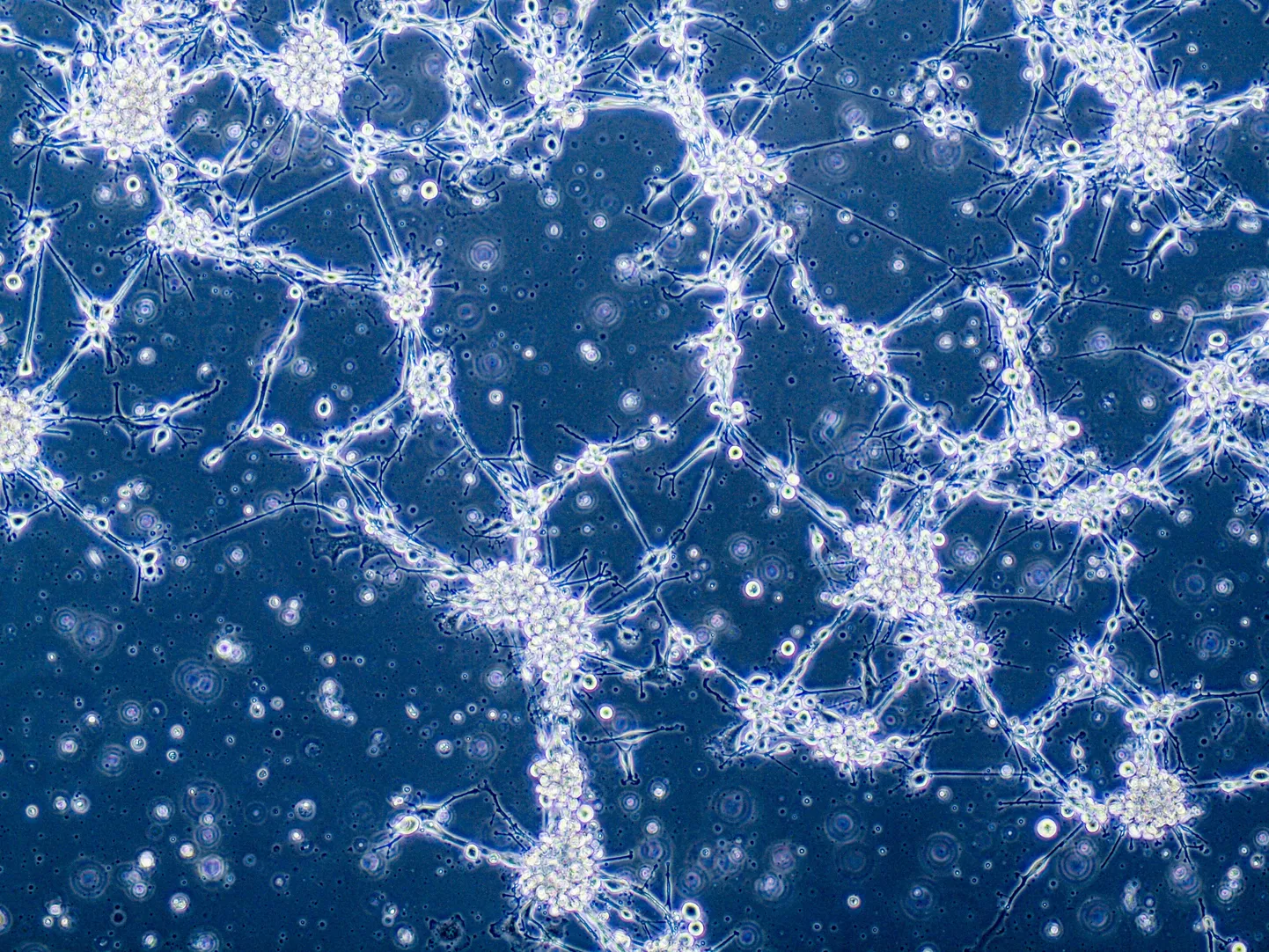 Glioblastoomi rakud. Pilt on illustreeriv.