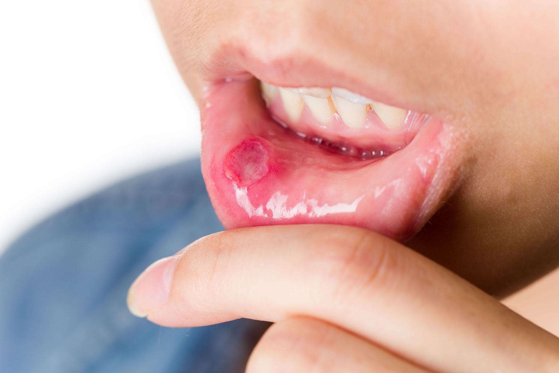 Herpes võib esineda huultel, näopiirkonans ja suus või genitaalidel.