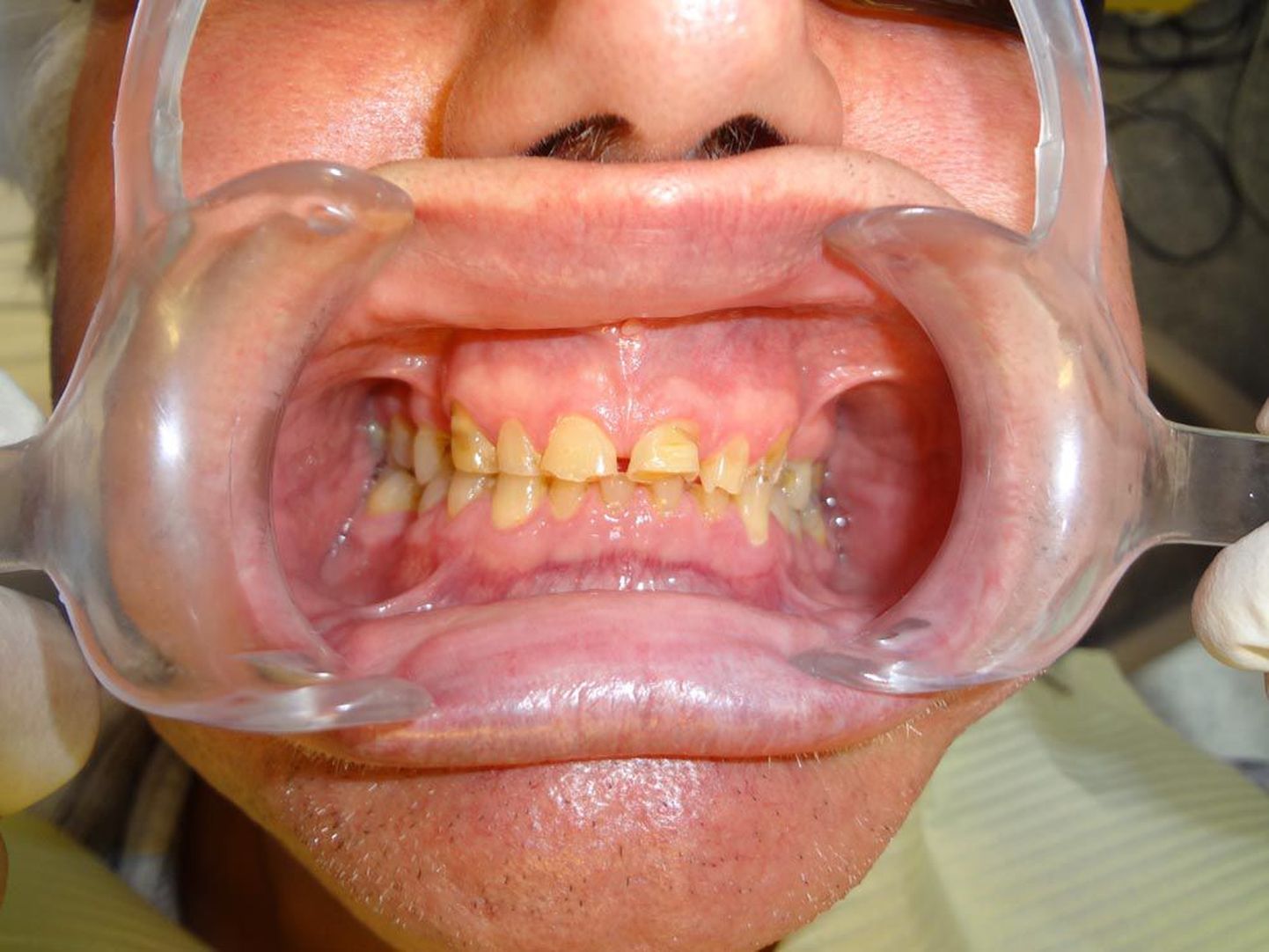 Ulatusliku hammaste kulumise tagajärjel tekkinud mikromõrad ja hambakaela kiilukujulised defektid.