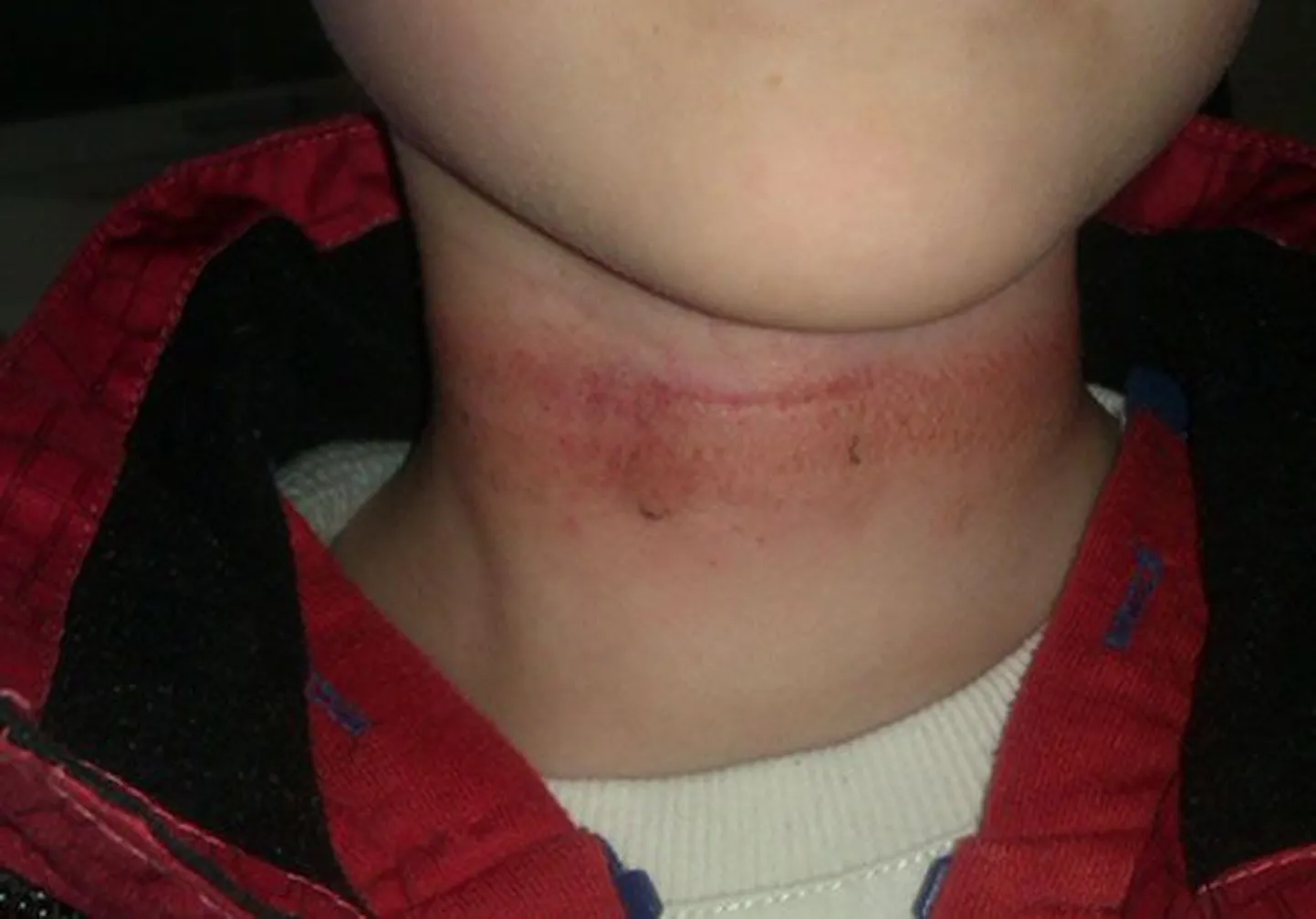Lasteaias salli pidi kiige külge kinni jäänud laps vigastas kaela, kuid õpetaja kiirabisse ega emale ei helistanud.