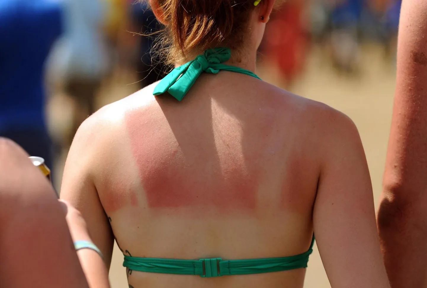 Lapsepõlves saadud päikesepõletused on kõige suurem melanoomi tekkerisk.
