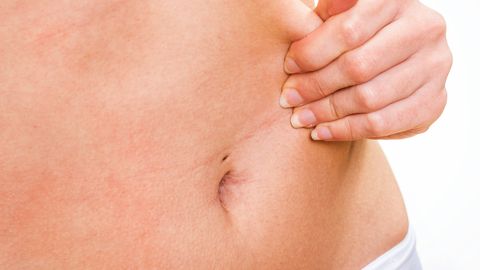 Lipoomid pole tavaliselt ohtlikud, aga hakkavad tihtilugu häirima inimest esteetiliselt. Lipoomid pole tavaliselt ohtlikud, aga hakkavad tihtilugu häirima inimest esteetiliselt.
