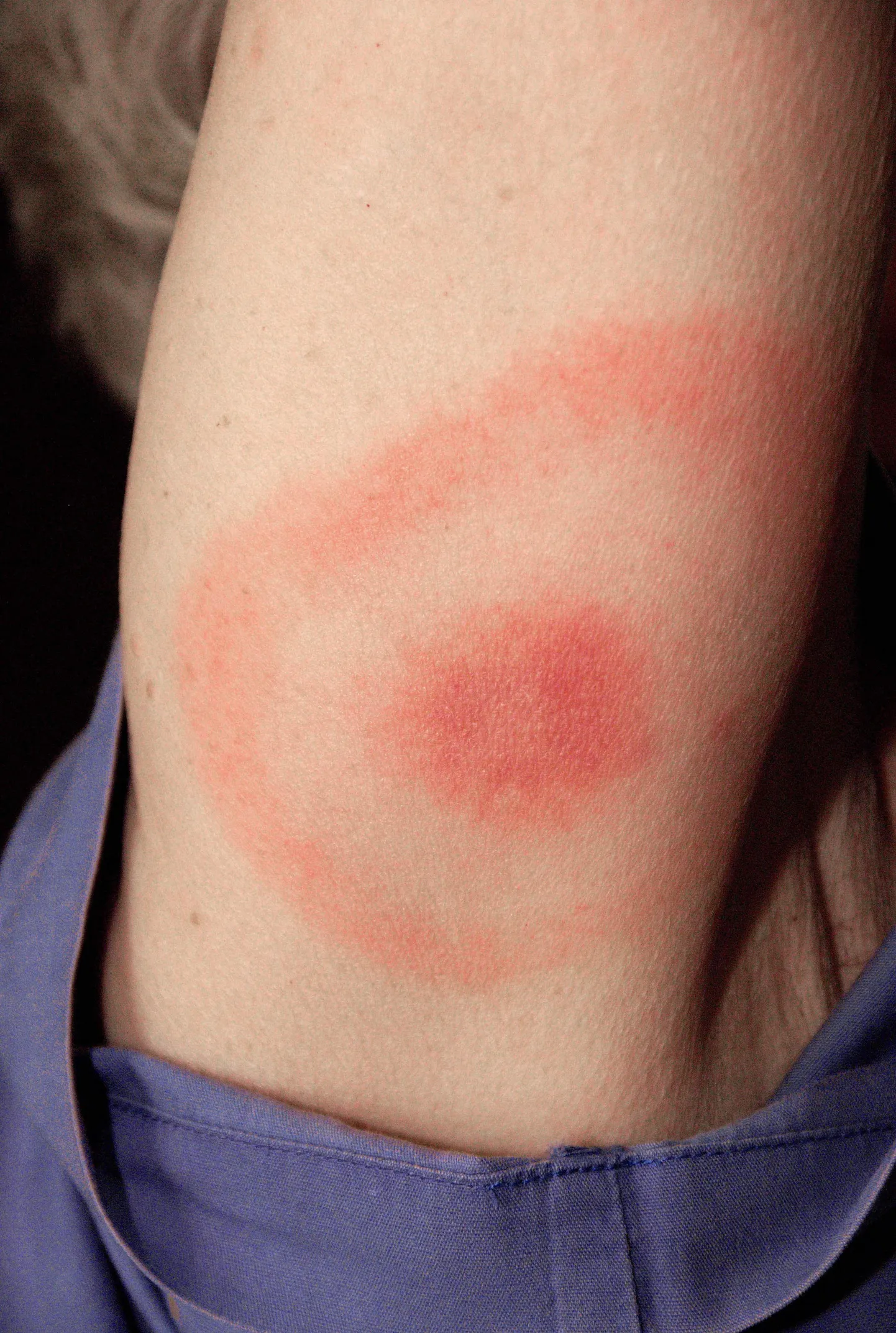 Lyme´i tõve ehk borrelioosi sümptomid