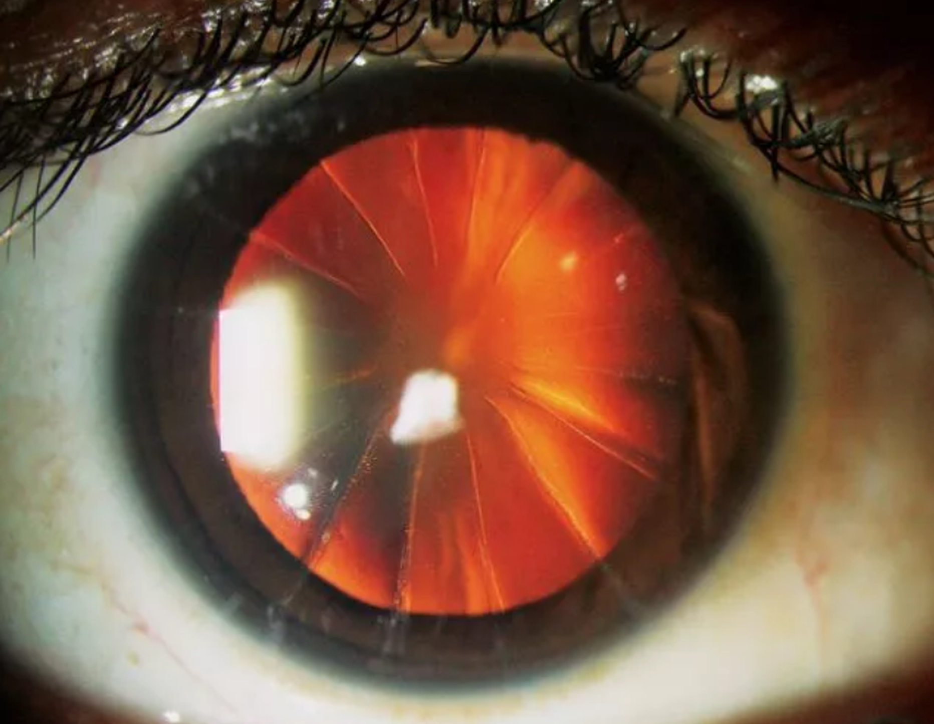 Kunagise populaarse silmaoperatsiooni tulemus