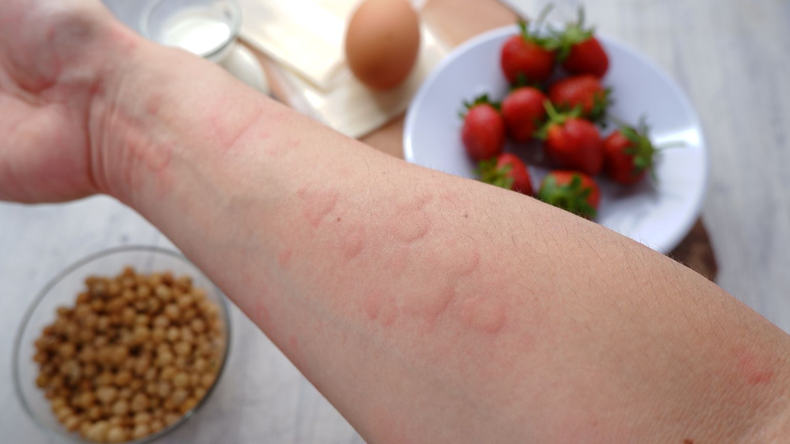 Suveajal vaevavad inimesi mitmed allergiad.