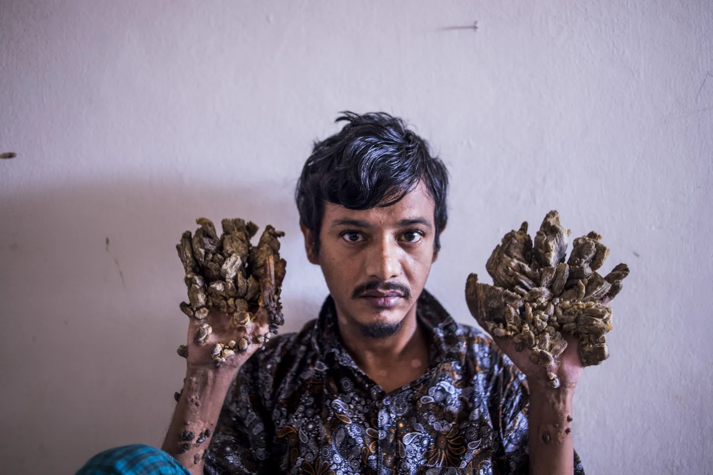 Bangladešas "koka cilvēks" Abuls Badžandars.