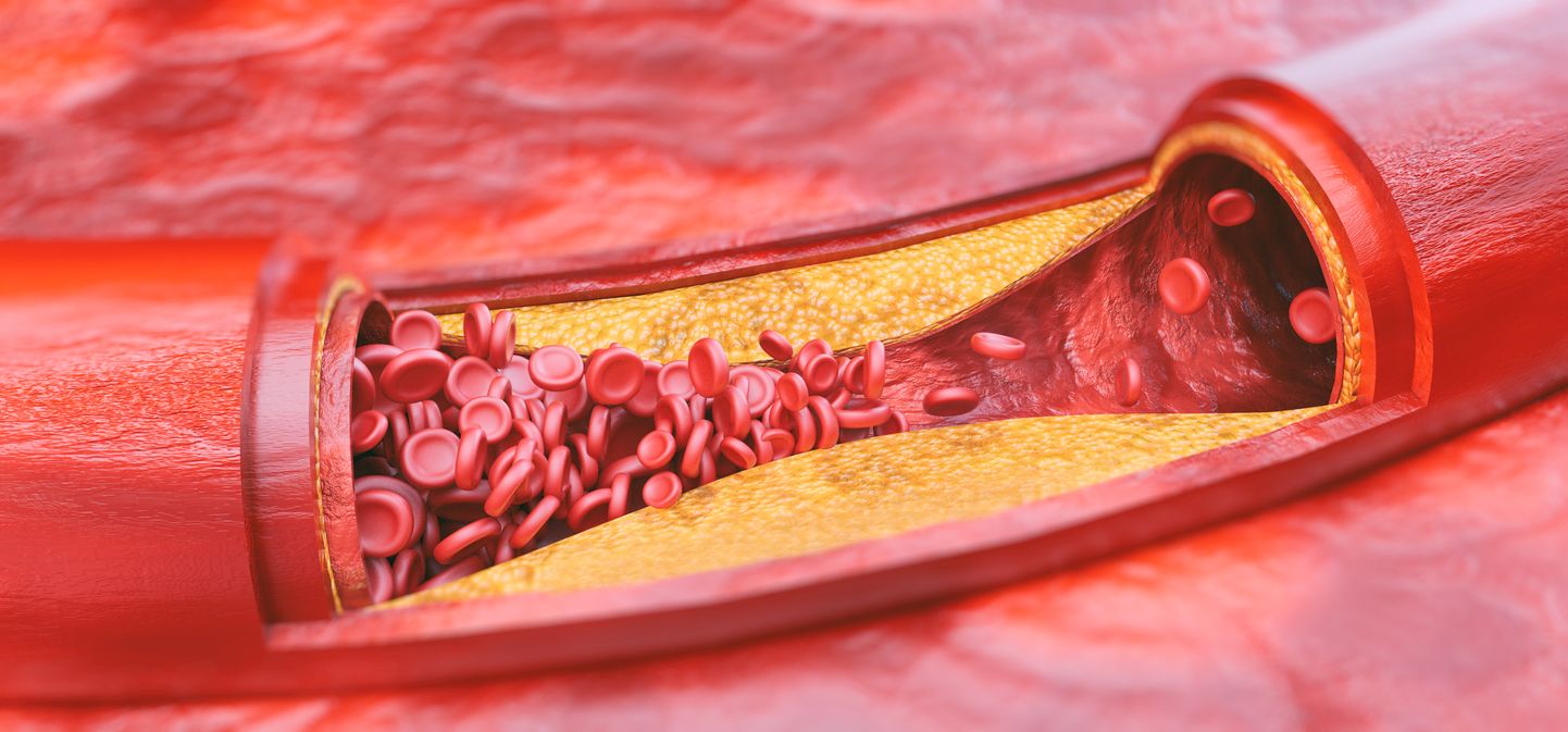 Ateroskleroos ehk arterite lubjastumine. Pilt on illustratiivne.