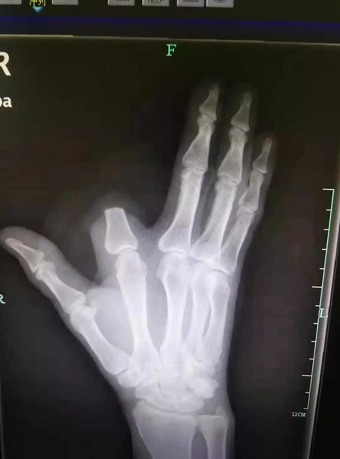 Arstidel ei õnnestunud amputeeritud sõrme tagasi panna.