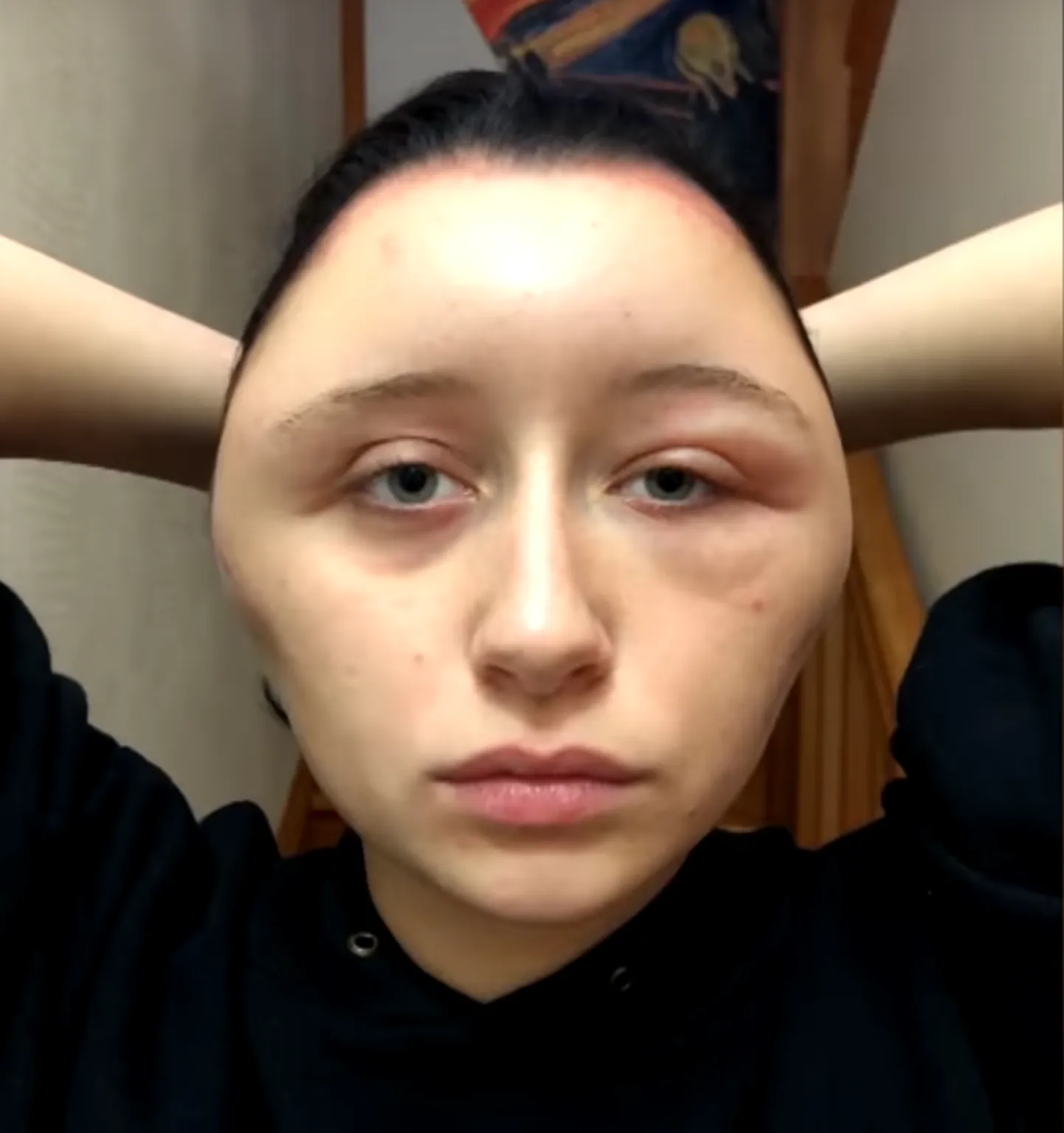 Аллергической реакцией на краску для волос, 19-летняя француженка Эстель