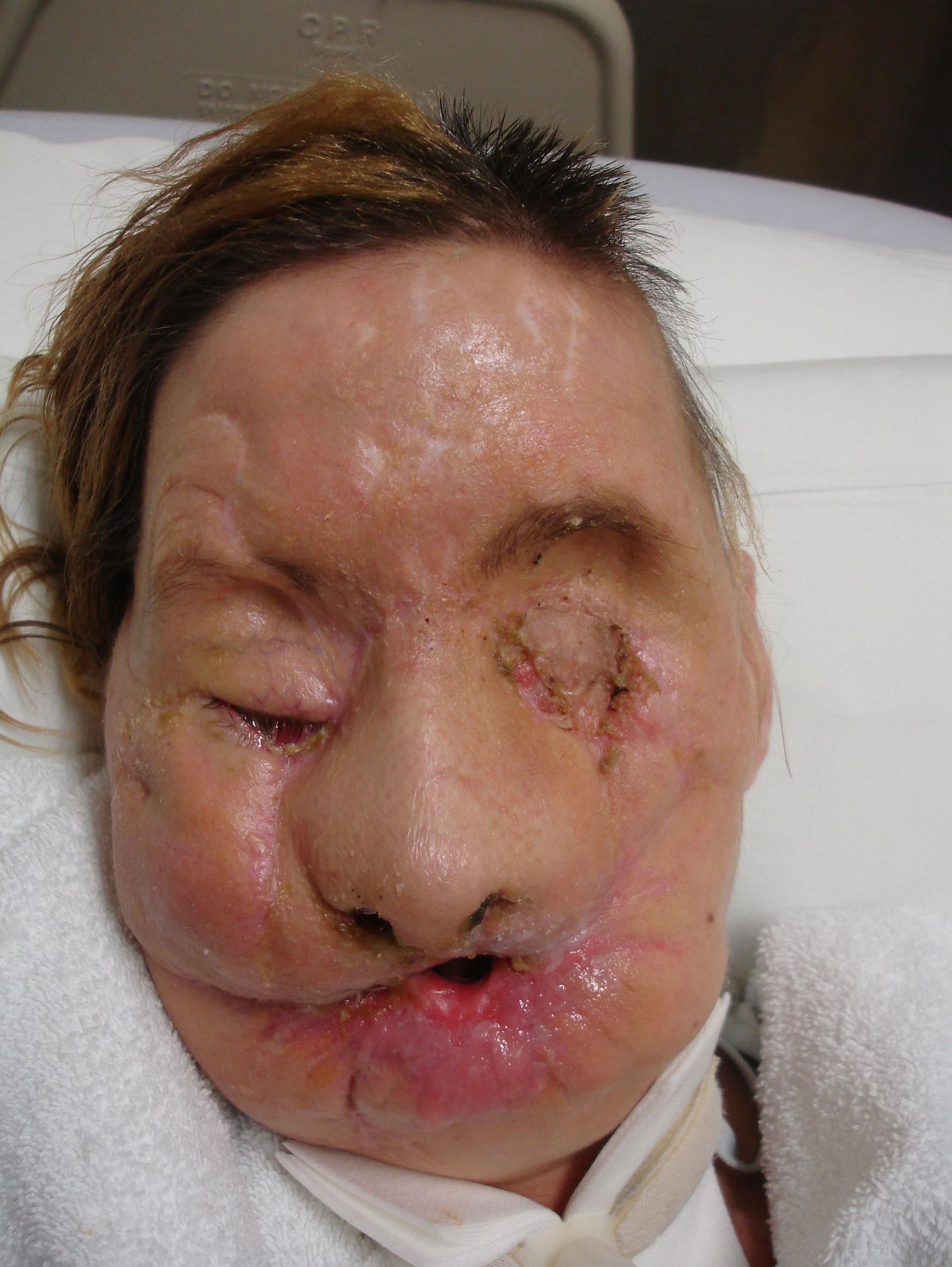 Näosiirdamise saanud Charla Nash enne operatsiooni