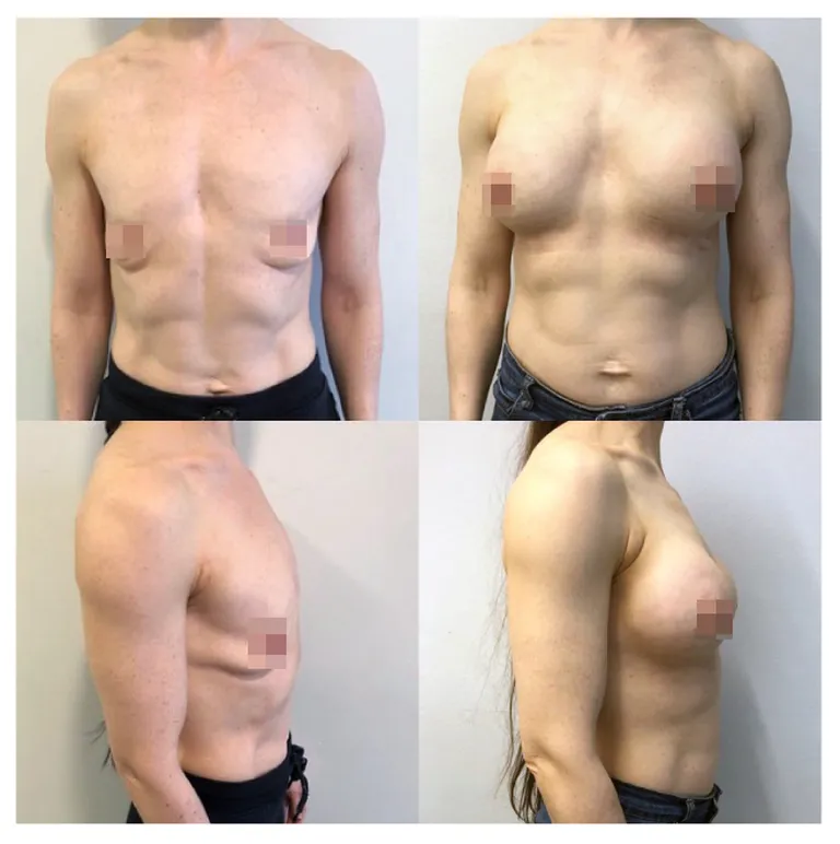 Rindade suurendamine, dr. Siim Simmo, Health Clinic, 3 nädalat peale operatsiooni.