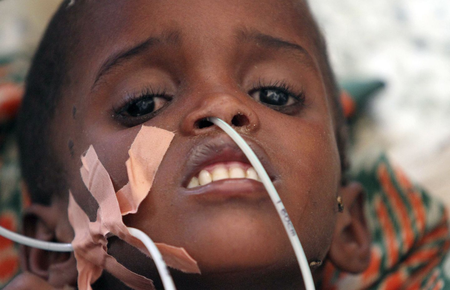 Alatoidetud Somaalia laps haiglas.