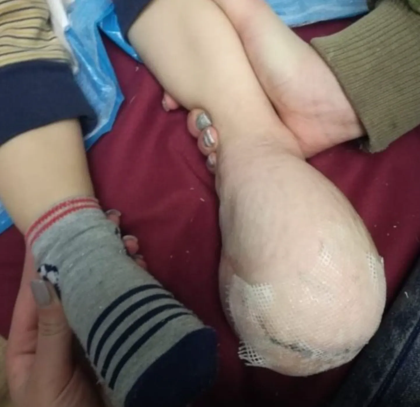 Rasvkasvaja muutis poisi jala ümaraks.