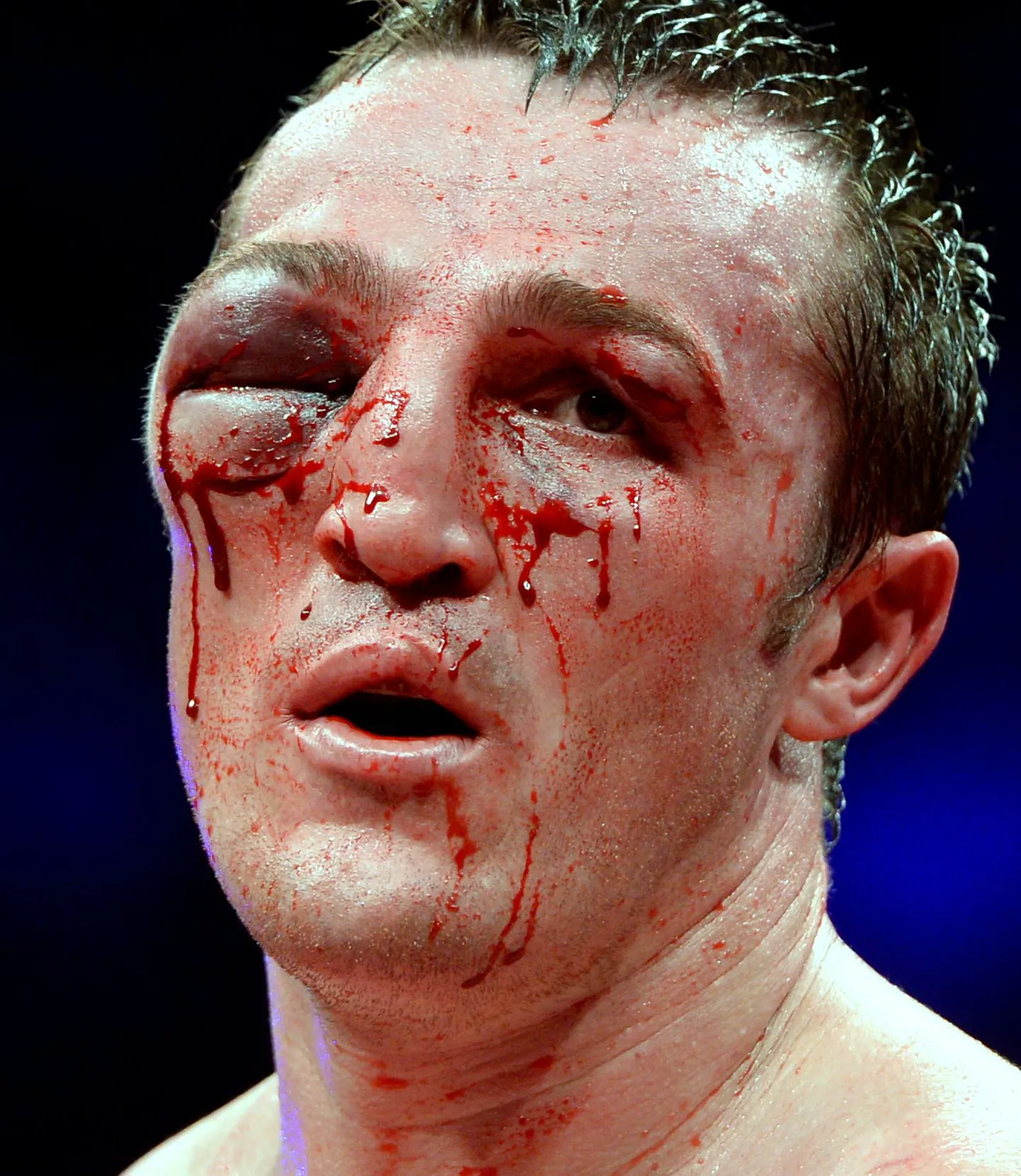 Denis Lebedev sai matšis Guillermo Jonesi vastu kohutava silmavigastuse.