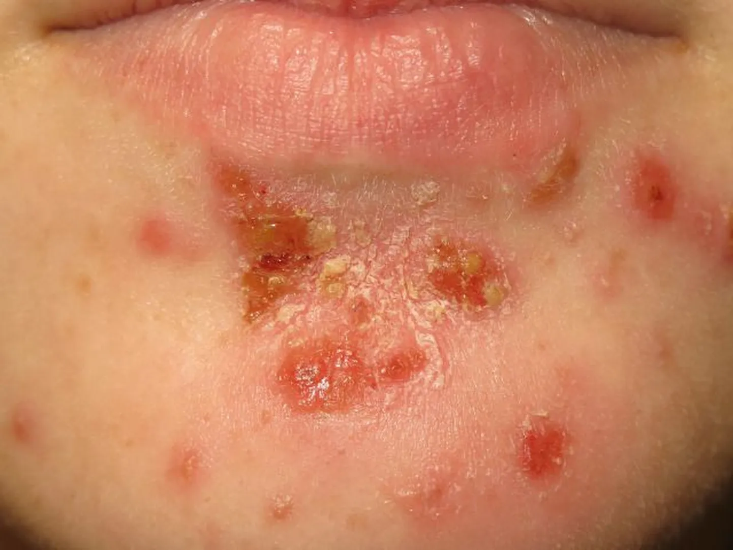 Nakkav nahamädapõletik ehk impetiigo.