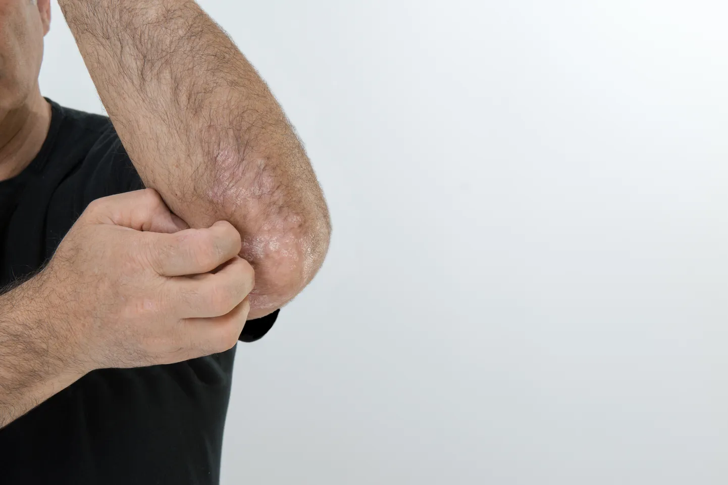 Psoriaas tekitab nahale punaseid, ketendavaid ja sügelevaid laike.