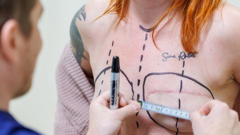 PHOTOS ⟩ Life after cancer: Breast reconstruction helps women 'become women again'