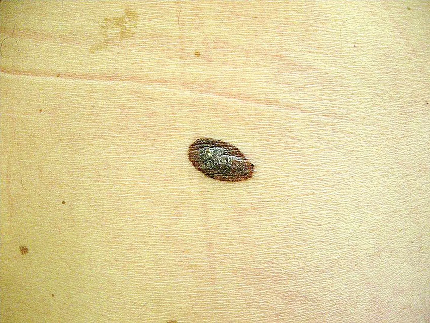 Pigmendilaik, mis pealtnäha on sümmeetriline ja ohutu, kuid juba keskosast muutunud ja tegelikult melanoom.