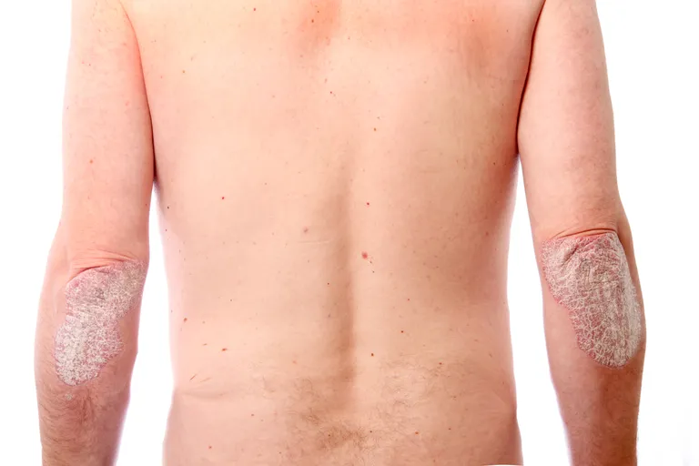 Psoriaas.