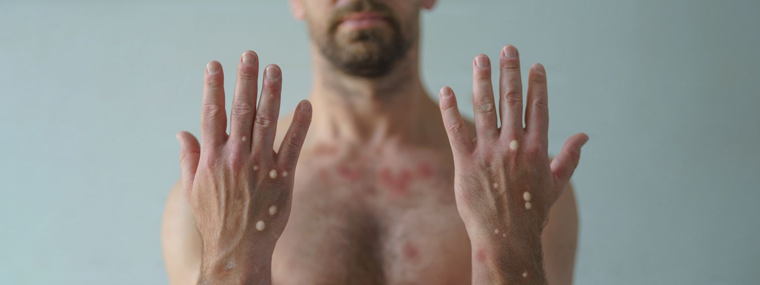 Ahvirõugete viirusest põhjustatud nahalööve tekib 1-3 päeva pärast palaviku teket. Lööbega on haaratud enamasti nägu, peopesad, jalatallad, suguelundid, vähem kehatüvi. Allikas: Terviseamet