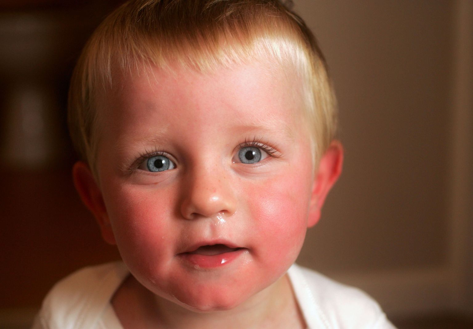Pähkliallergia tõttu on lapse nägupunetav ja suuümbrus paistes.
