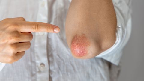 TESTS AR BALVU ⟩ 11 mīti par psoriāzi – cik no tiem tu spēj atmaskot?