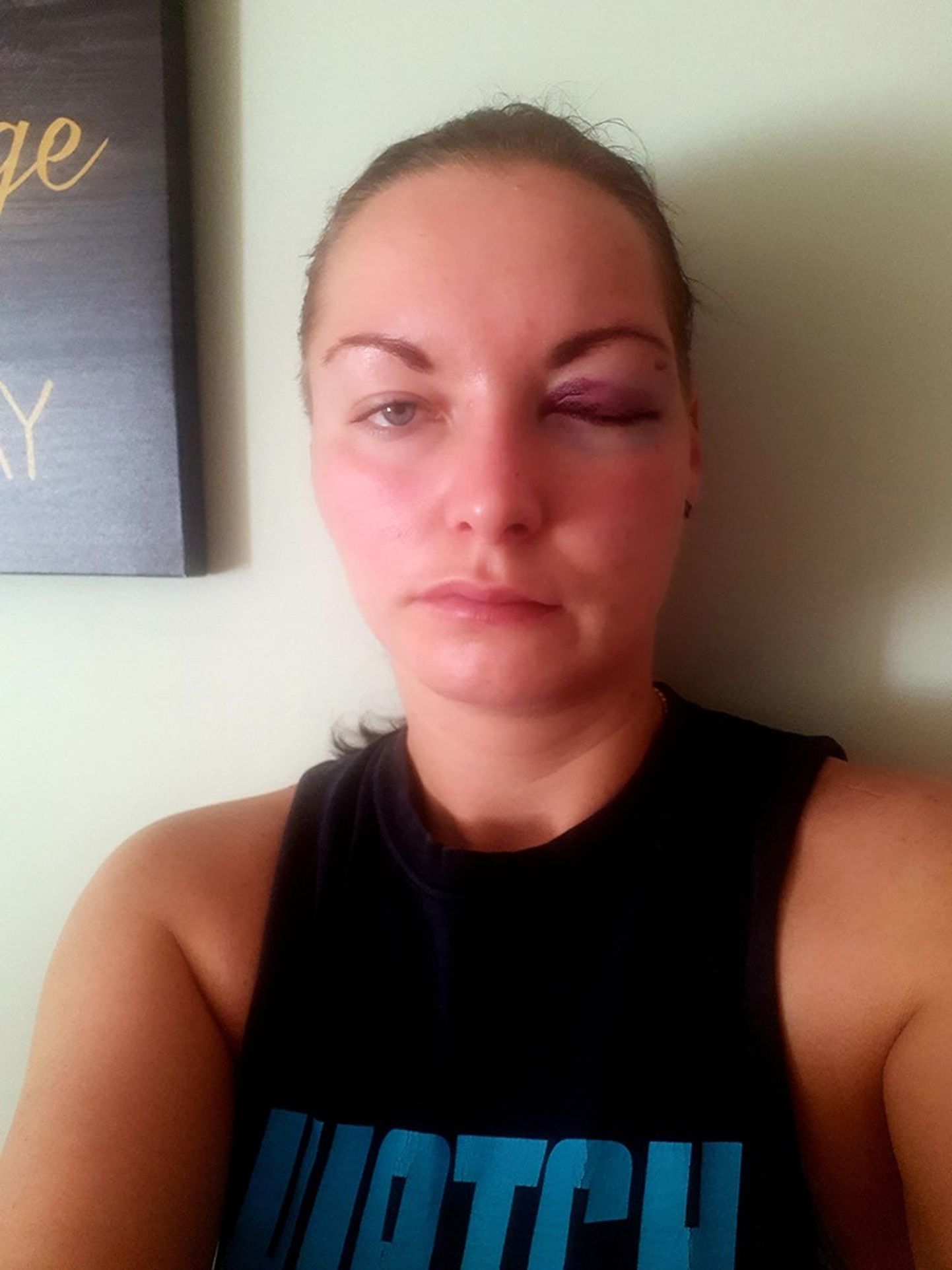 27-aastane Mari-Liis Klein postitas septembris oma Facebooki seinale endast sinise silmaga foto, mis pidavat tõestama, et teda tabasid Tartus Tähe tänaval ründaja rusikahoobid. Nüüd väidab prokuratuur, et tegelikult teda ei löödud.