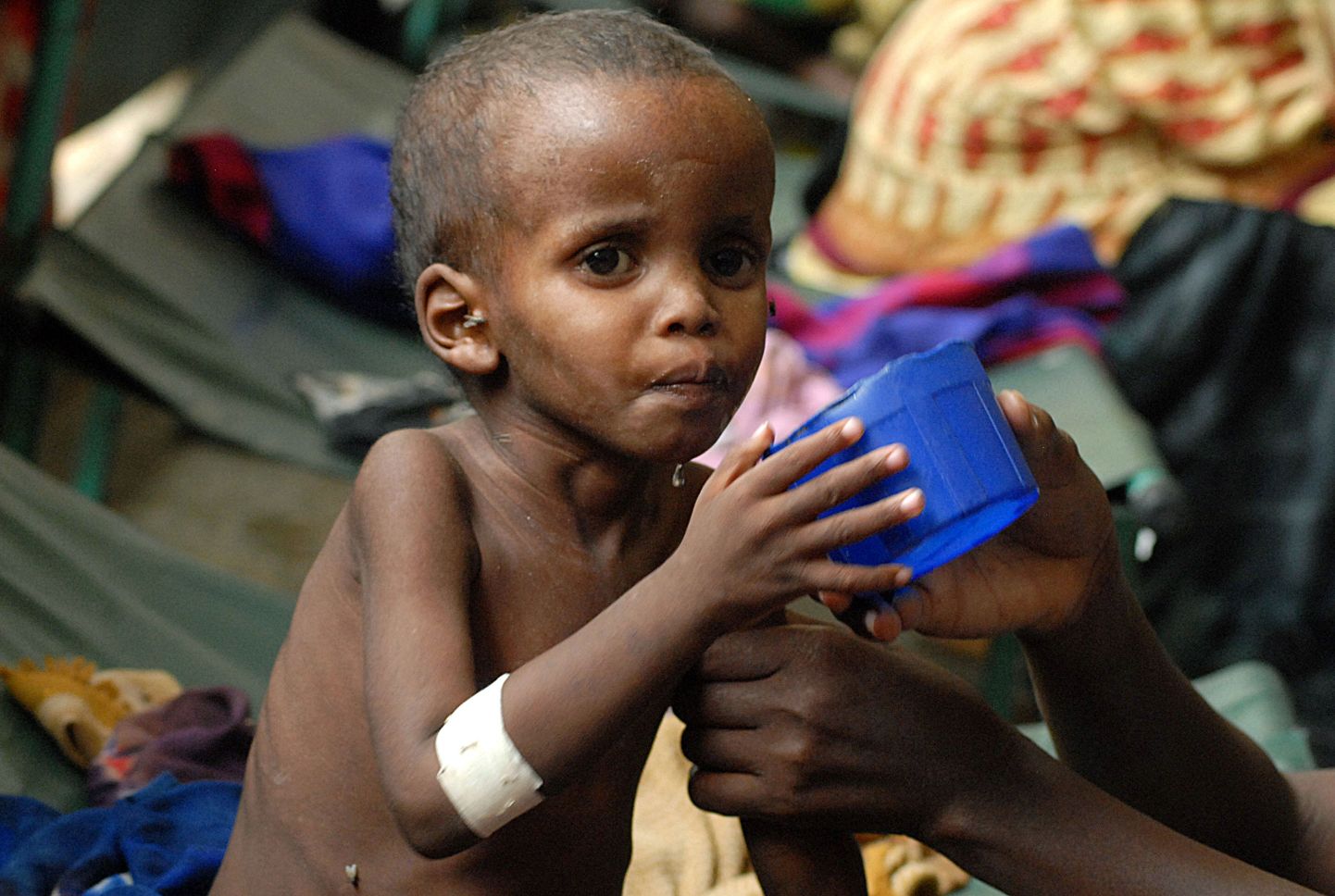 Alatoidetud Somaalia laps.