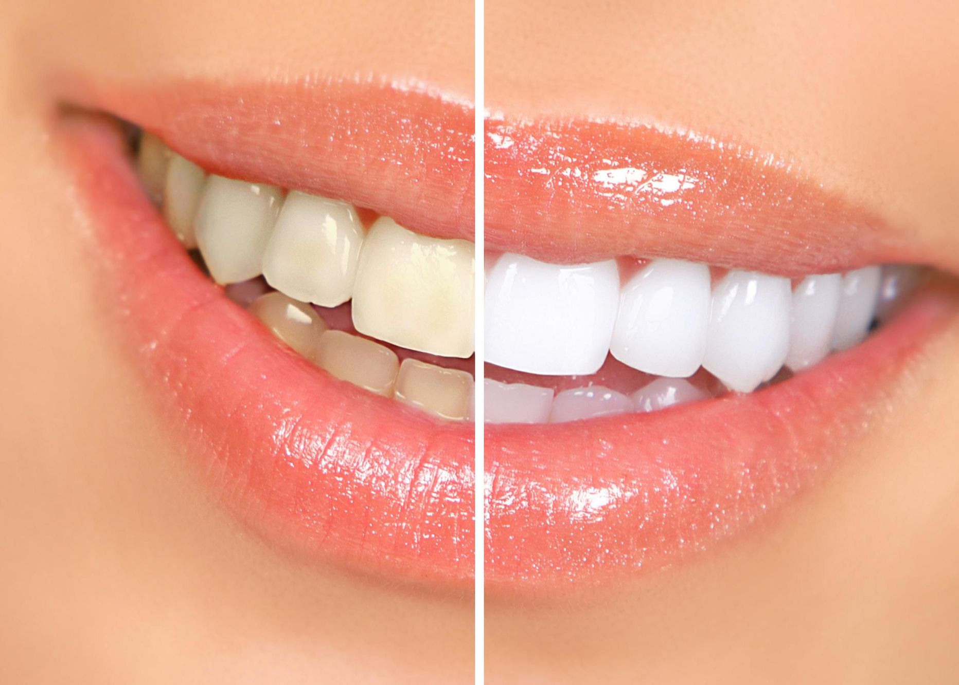 Отбеливание зубов считается косметической процедурой, но у нее могут быть опасные побочные эффекты.