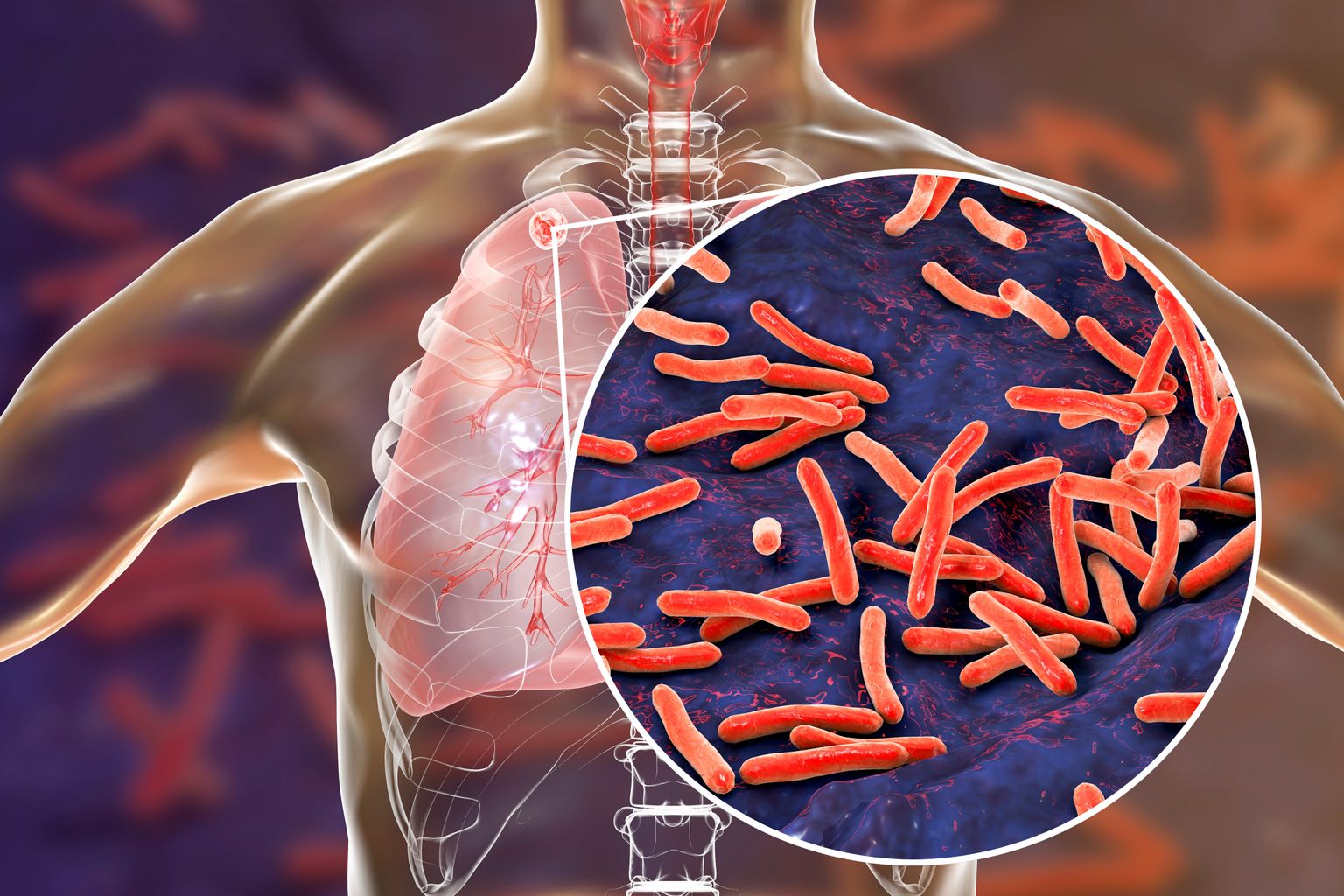 Tuberkuloos paikneb peamiselt kopsudes, kuid võib kahjustada kõiki elundeid.