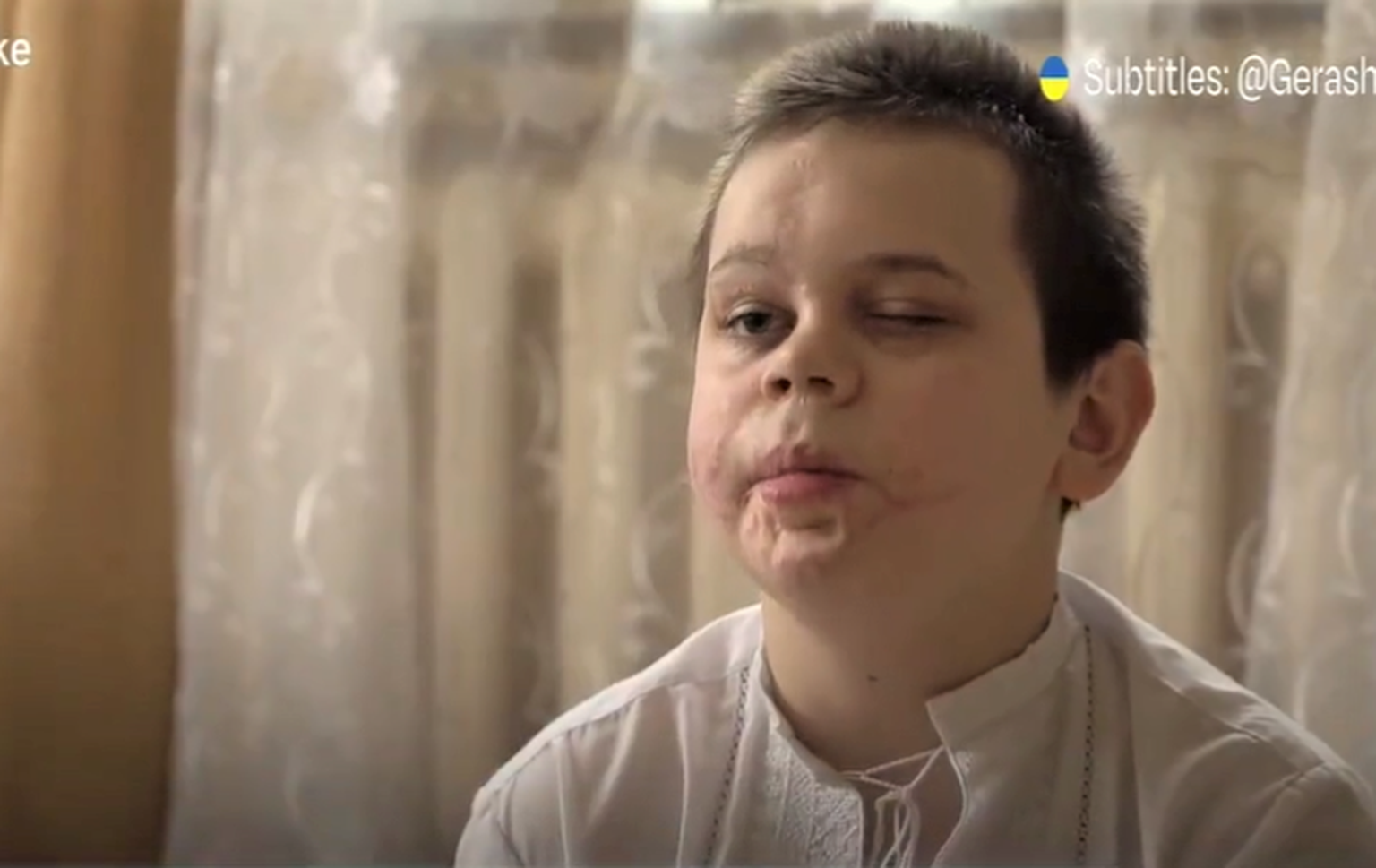 12-aastane Ukraina poiss Mykola, kes kaotas lõhkemata mürsku lüües oma jäsemed.