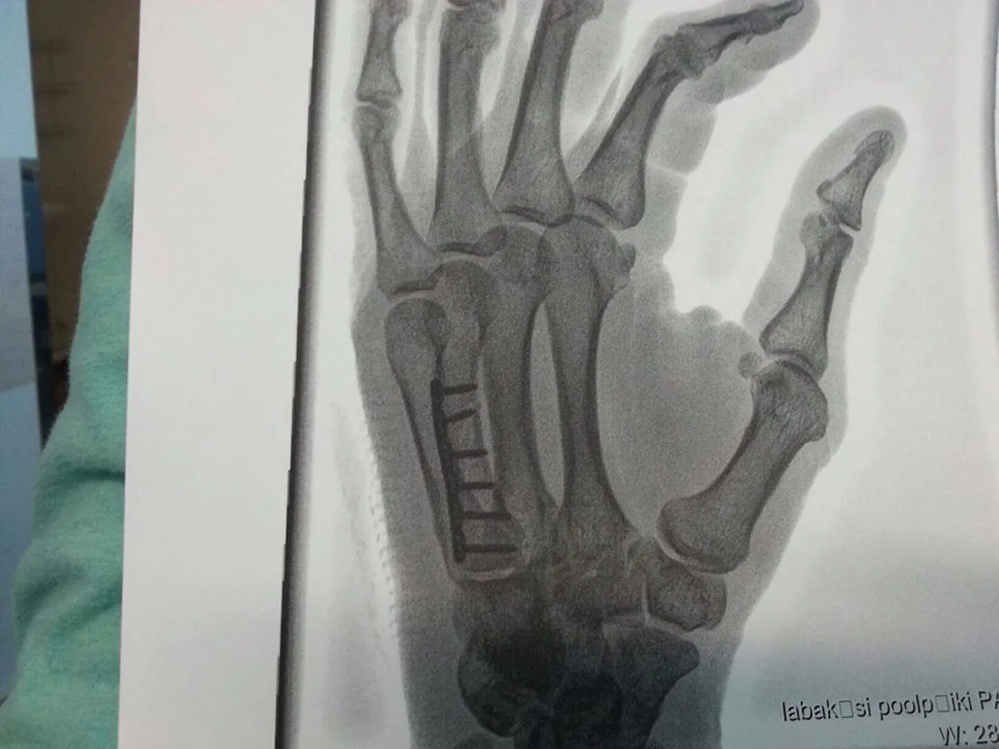 Mart Meeru käsi pärast operatsiooni