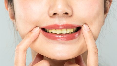 VÄLDI NENDE TOODETE KASUTAMIST ⟩ Hambaarst paljastab, mis muudab teie hambad kollaseks