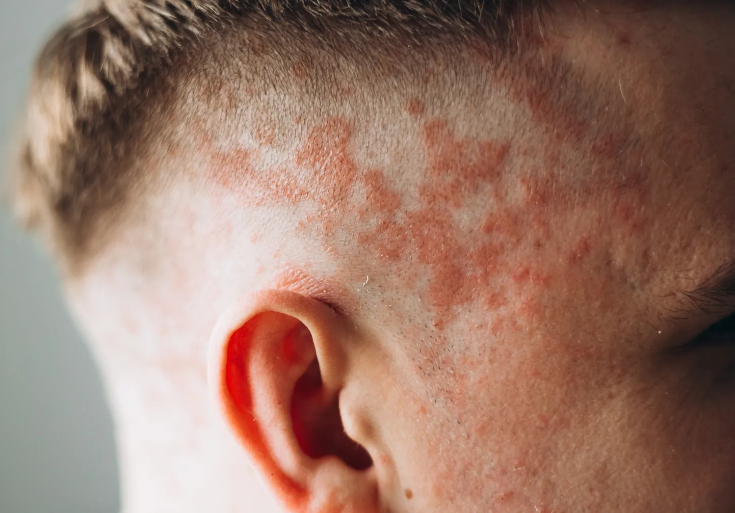 Psoriaas
