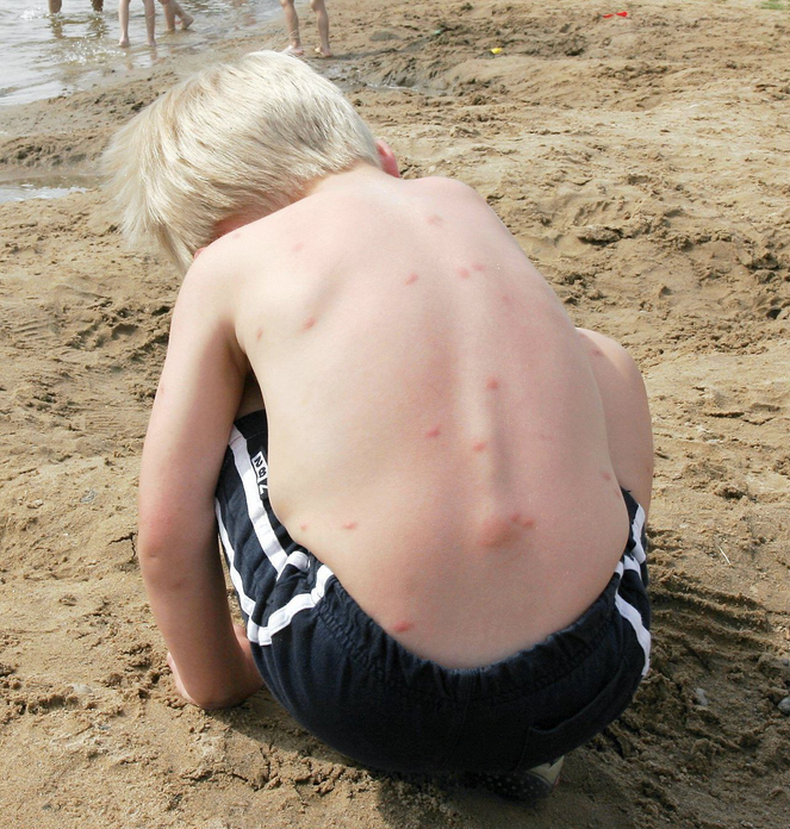 Kuumadel suvepäevadel, kui veetemperatuur kerkib Viljandi järves üle 20 kraadi, on sügelev lööve kimbutanud allergilisema nahaga ujujaid juba mitukümmend aastat.